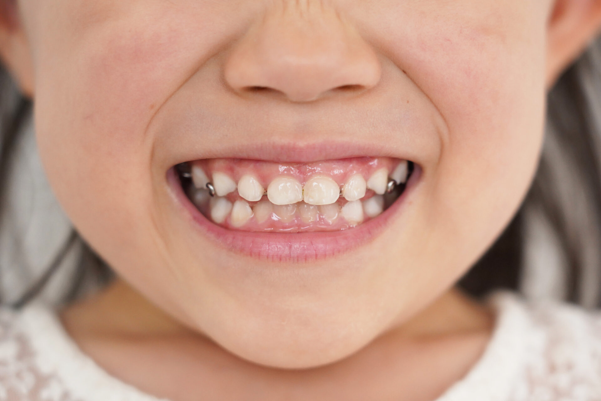 子供の矯正は何歳ごろから始める？